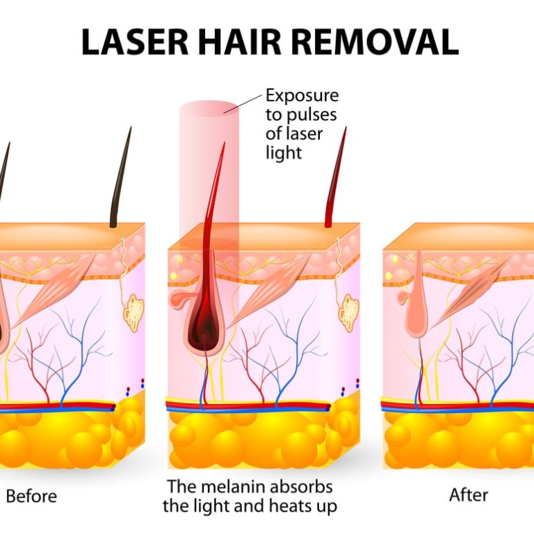 Laser,Hair,Removal.