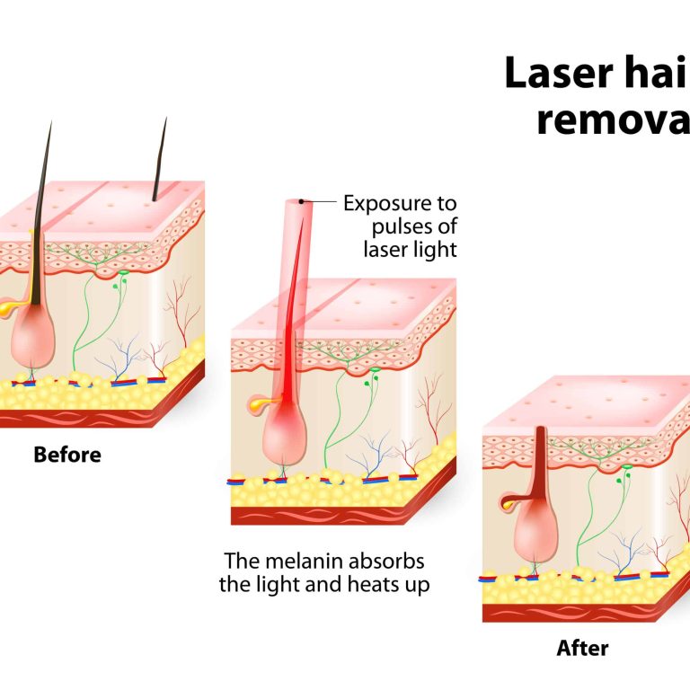 Laser,Hair,Removal